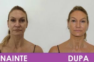 Lifting fara operatie, cea mai cautata procedura cosmetica, acum si in PLOIESTI. Vezi cum poti arata cu 10 ani mai tanara, fara durere si fara bisturiu