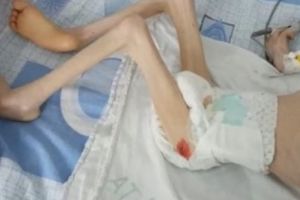 Barbarie la Botoşani. Un copil cu handicap grav a fost înfometat de a ajuns să cântărească şase kilograme la 12 ani