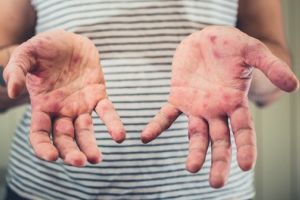 Bihorul, iar pe primul loc în ţară la îmbolnăviri de rujeolă: 25 de cazuri noi, în ultima săptămână