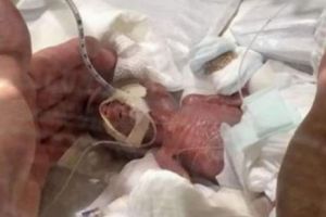 Premieră medicală. S-a născut cel mai mic beleluş din lume. Medicii au fost uluiţi