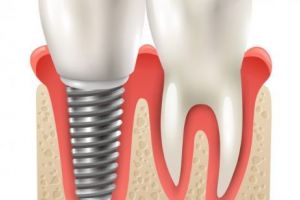 Ce trebuie să ştii atunci când vrei să faci un implant dentar?