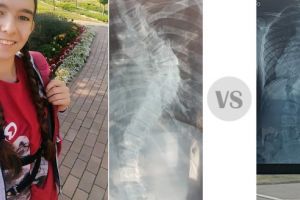 De 8 martie, ajută o fetiţă să ducă o viaţă normală: Alexia are nevoie de ajutorul tău să învingă scolioza