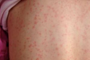 111 cazuri noi de rujeolă au fost confirmate!