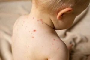 Numărul cazurilor de rujeolă, din nou în creştere în Prahova