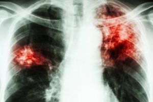 Peste 250 de cazuri noi de tuberculoză, înregistrate în 2018 în judeţul Vaslui