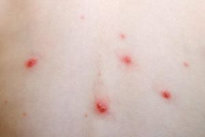 Două focare de varicelă în judeţul Olt. Zeci de copii s-au îmbolnăvit