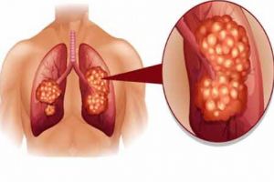 Program de finanţare a markerilor moleculari, pentru un diagnostic primar precis în cancerul pulmonar