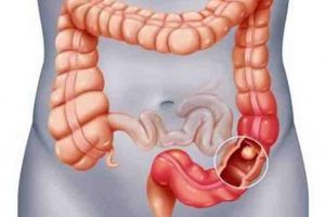 Cancerul de colon, o boală tratabilă