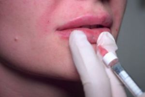 Medic fals remodelează buzele, fesele sau sânii în apartamentul său. Clienţii sunt racolaţi de pe social media. Preţuri la jumătate faţă de o clinică specializată