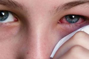 Cum acţionăm în cazul arsurilor chimice la ochi