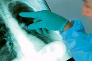 Zeci de hunedoreni diagnosticaţi cu tuberculoză