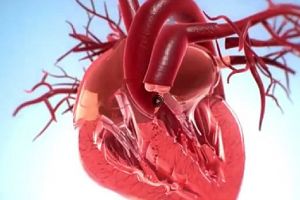 Valve aortice viabile create in vitro, folosind celulele pacientului