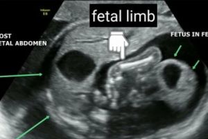 Caz şocant! Fetus in fetu: Un făt s-a format în pântecele gemenei. Foto în articol
