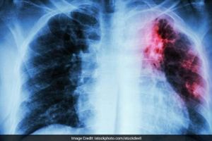 Pacienţii cu tuberculoză nu se prezintă la medic de ruşine