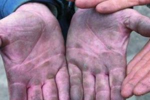 Focar de hepatită la Blaj