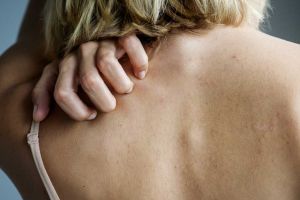 Eczema – simptome, cauze şi tipuri de tratament