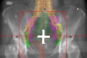 Endometrioza, boala care devastează femeile din România. „Durează cam 7 ani până când pacientul este diagnosticat corect”