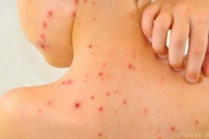 Ne paşte epidemia de rujeolă? Alte zeci de cazuri confirmate