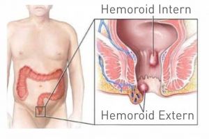 Operaţia de hemoroizi – care sunt avantajele acesteia?