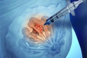 Descoperire incredibilă! Un leac pentru lepră poate fi folosit în tratamentul cancerului de sân