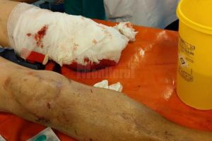 Poliţişti nevoiţi să transporte în portbagajul Loganului piciorul amputat al unui tânăr