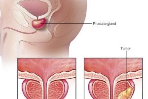Un cancer tipic masculin: cancerul de prostată – simptome, diagnostic, tratament