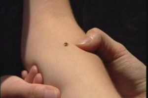 Atenţie la înţepăturile de căpuşe!