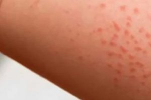 SCARLATINĂ în ŞCOLI din ARGEŞ