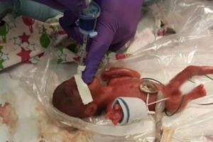 Salvat miraculos. Cel mai mic bebeluş din lume cântărea la naştere cât un măr