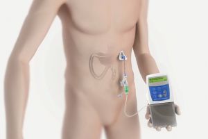 VIDEO- O nouă modalitate de a trata bolnavii de Parkinson, la Braşov