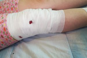 FOTO – Fetiţă  din Sibiu atacată de un câine când se întorcea de la şcoală. A muşcat-o de faţă, mâini şi picioare