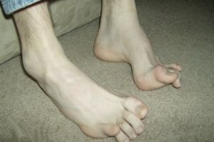 Boala Charcot Marie Tooth – suferinzii au prima lor asociaţie în România