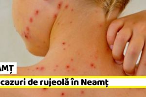 NEAMȚ: 42 de cazuri de rujeolă în Neamţ, în ultima săptămână