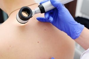 Târgu-Mureş: Campanie de informare, educaţie şi depistare a cancerului de piele