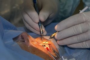 O femeie din Botoşani, aflată în moarte cerebrală, a redat vederea unei alte femei