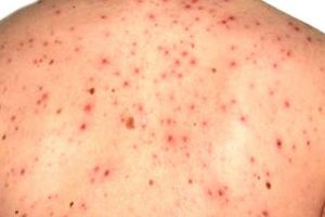 Creşte incidenţa rujeolei; în luna mai numărul de cazuri s-a dublat