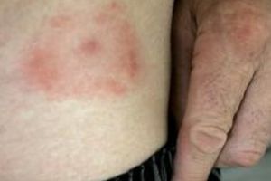 Doi piteşteni, DIAGNOSTICAŢI cu boala Lyme!