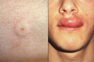 O femeie din Botoşani a încercat să mănânce un fruct şi a ajuns la spital. A fost înţepată de buză de o albină