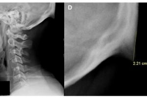 DESCOPERIRE: Un nou os se dezvoltă în craniul tinerilor din cauza telefoanelor mobile
