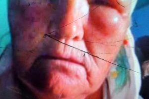 FOTO O femeie din Botoşani s-a ales cu faţa tumefiată după ce a fost atacată de albinele vecinului. „Într-o lună, a păţit-o de 4 ori”