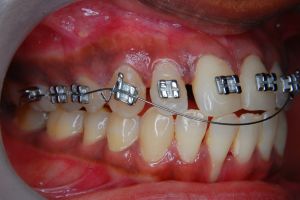 Aparatul dentar la copii: necesitate sau modă?