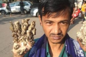 Dorinţă şocantă! Un bărbat care suferă de sindromul „omului copac” a cerut să i se amputeze mâinile pentru că nu mai poate de durere