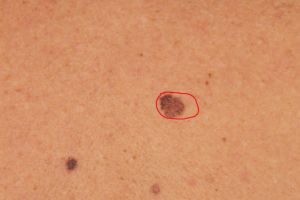 Cancerul de piele – prevenţie, factori de risc, simptome şi tratament