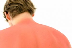 Un bărbat a ajuns la spital cu arsuri solare pe 40% din suprafaţa corpului