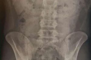 Un cetăţean ucrainean a fost prins pe aeroportul Otopeni cu 143 de grame de COCAINĂ ascunsă în stomac