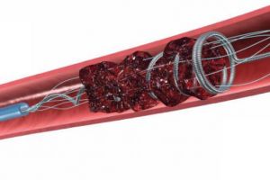 Rata de trombectomii în România este de 0,1%