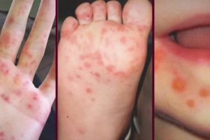 Boala numită „Gură-mână-picior”, extrem de contagioasă, a afectat în ultima lună ...