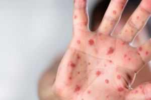 Avalanşă de cazuri de rujeolă în România – Zeci de cazuri în câteva zile