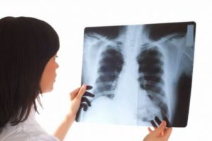 75 la sută din totalul cazurilor de cancer pulmonar sunt diagnosticate în stadiu inoperabil