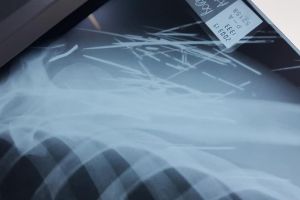 FOTO Șocant! Un bărbat din Botoşani a ajuns la spital cu mai multe ace înfipte în corp. Medic: Nu am mai văzut aşa ceva